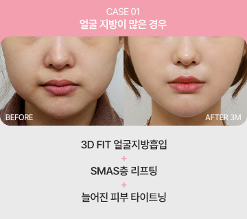 에이탑성형외과 심술보리프팅 얼굴 지방이 많은 경우 이미지