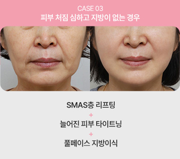 에이탑성형외과 심술보리프팅 피부 처짐 심하고 지방이 없는 경우 이미지