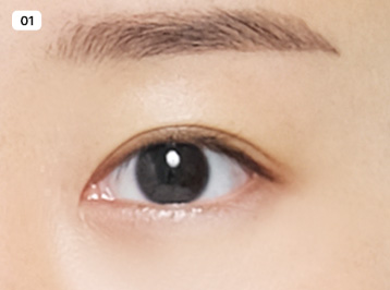 에이탑성형외과 눈매교정 눈꺼풀처짐 안검하수 이미지
