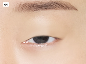 에이탑성형외과 눈매교정 눈꺼풀처짐 안검하수 이미지