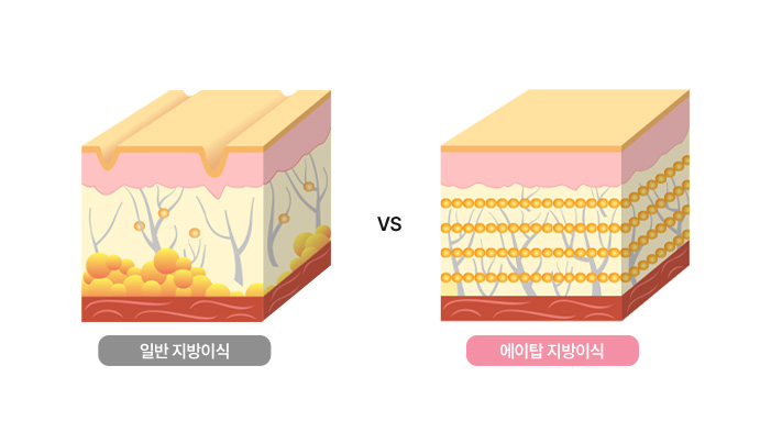 에이탑성형외과 밸런스 포인트 기술력 이미지