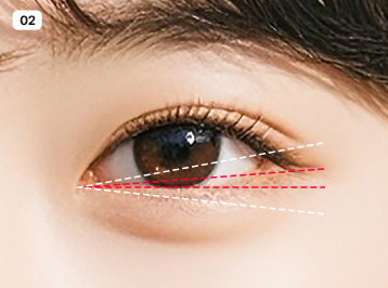 에이탑성형외과 FIT 트임 수술방법