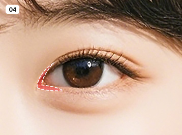 에이탑성형외과 FIT 트임 수술방법