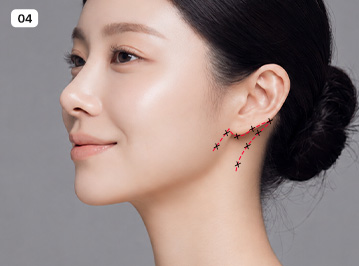 에이탑성형외과 목 거상술 수술방법