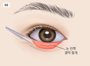 에이탑성형외과 눈밑지방 수술방법 이미지
