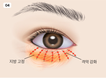 에이탑성형외과 눈밑지방 수술방법 이미지