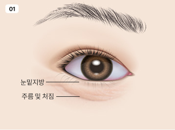 에이탑성형외과 눈밑지방제거 수술방법 이미지