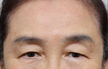 에이탑성형외과 상안검+이마거상 수술방법