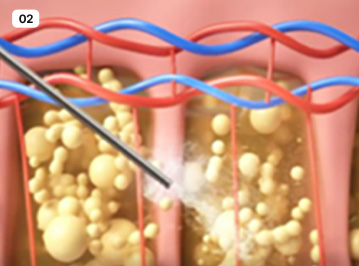 에이탑성형외과 3d-ct 엘싸 얼굴 지방흡입 수술방법