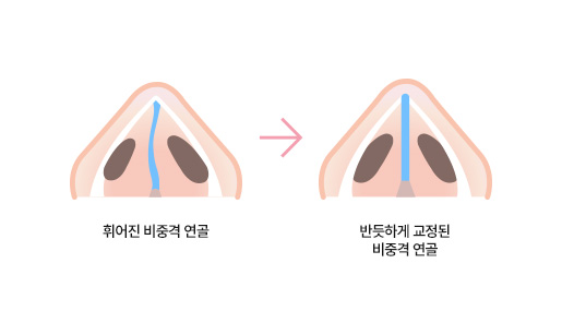 에이탑성형외과 실비혜택 비중격 만곡증