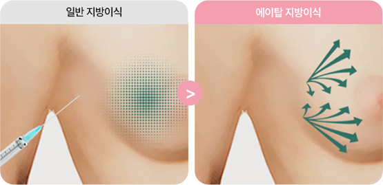 에이탑성형외과 가슴지방이식 밀착지방이식 기술