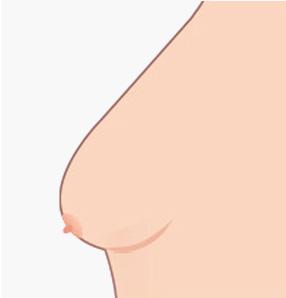 에이탑성형외과 가슴축소거상 가슴처짐 자가진단 유두가 가슴 밑 선에서 1cm 이내인 경우