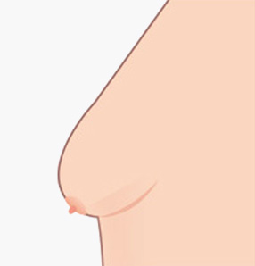 에이탑성형외과 가슴축소거상 가슴처짐 자가진단 유두가 가슴 밑 선에서 1-3cm 이내인 경우