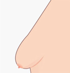 에이탑성형외과 가슴축소거상 가슴처짐 자가진단 에이탑성형외과 가슴축소거상 가슴처짐 자가진단 유두가 가슴 밑 선에서 1-3cm 이내인 경우