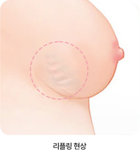 에이탑성형외과 가슴재수술 리플링 현상
