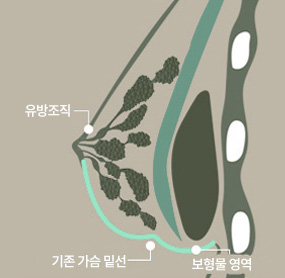 에이탑성형외과 가슴재수술 밑빠짐 / 더블라인 더블라인