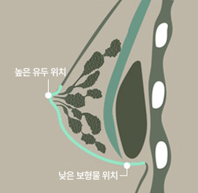에이탑성형외과 가슴재수술 밑빠짐 / 더블라인 밑빠짐