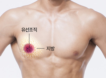 에이탑성형외과 남자 여유증 복합형