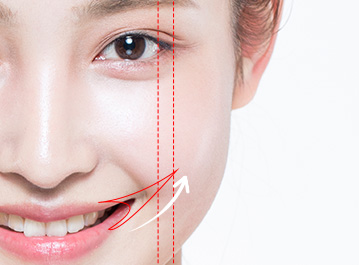 에이탑성형외과 웃을 때 입꼬리가 동공 외측 경계선을 넘는 경우