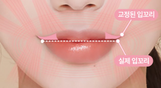 에이탑성형외과 입술 점막만 당겨 교정한 경우