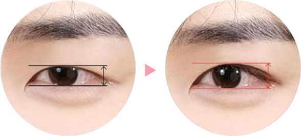 에이탑성형외과 남자 눈매교정 기술력 눈동자 노출량