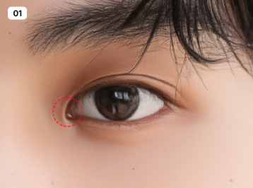 에이탑성형외과 남자 트임 디자인 진행
