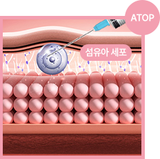 에이탑성형외과 에이탑 리쥬란 힐러 기술력 정확한 시술 깊이