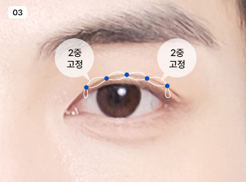 에이탑성형외과 남자 눈성형 슬림라인 눈성형 수술방법