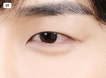 에이탑성형외과 남자 눈성형 인라인 눈성형 수술방법