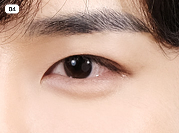 에이탑성형외과 남자 눈성형 인라인 눈성형 수술방법