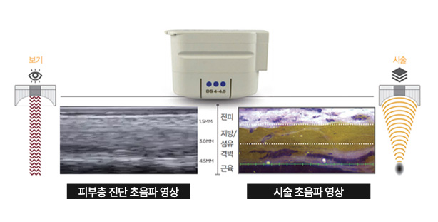 에이탑성형외과 울쎄라피프라임 특허받은 deepseetm 기술