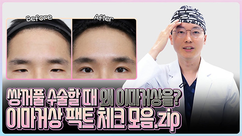 쌍꺼풀 수술할 때 이마거상 필수 케이스는? 이마거상은 왜 해야 하나요?