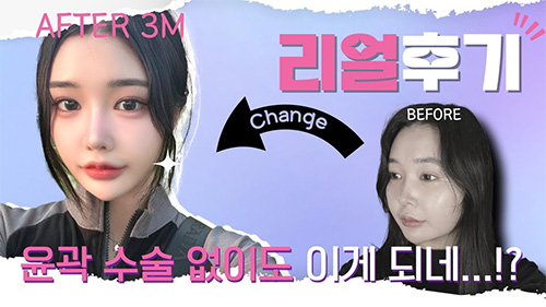 윤곽수술 NO! I 에이탑 얼굴지방흡입+실리프팅 리얼후기