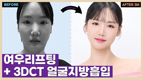 3D-CT얼굴지방흡입+실리프팅+여우리프팅 리얼후기