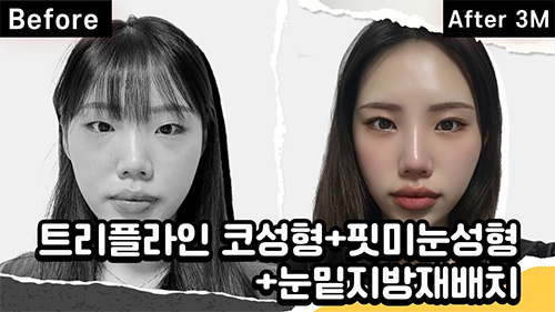 리얼후기 영상 (트리플라인 코성형+핏미눈성형+눈밑지방재배치)