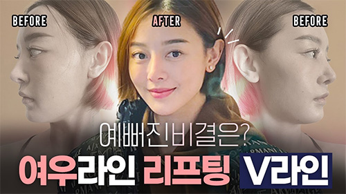 패인 부분은 채우고 + 갸름한 V라인으로 완성