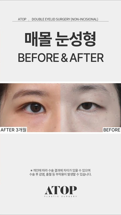 작은 눈이 이렇게 달라졌습니다…😱✨ 눈성형 비포애프터