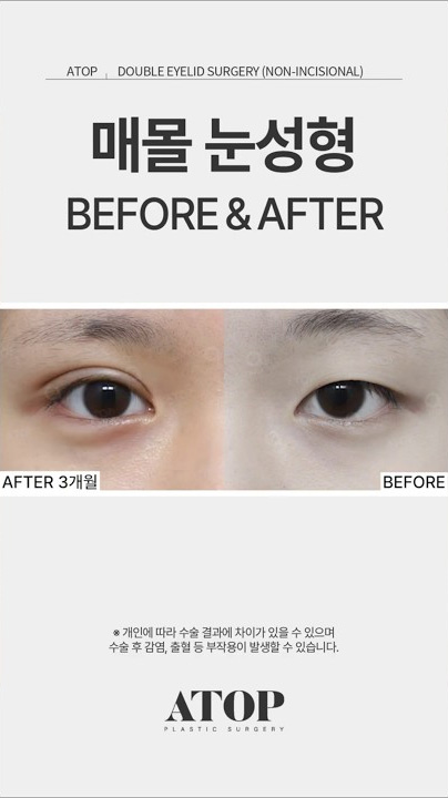 눈성형으로 180도 달라진 얼굴😱💖