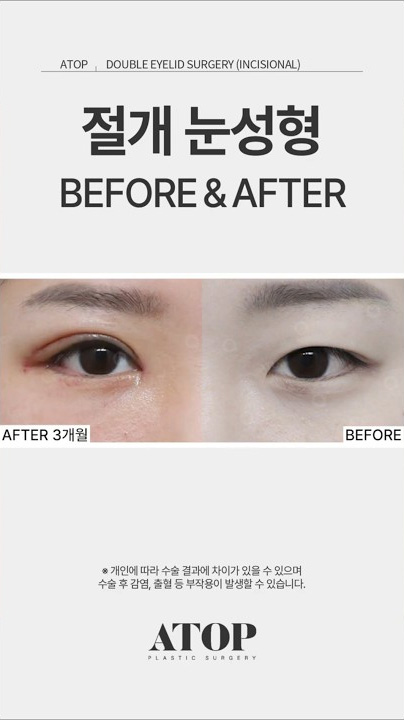 쌍수 3개월차 진짜 후기 | Before After✨