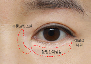 에이탑성형외과 하안검성형 눈꺼풀 처짐에 따라 변형된 눈모양
